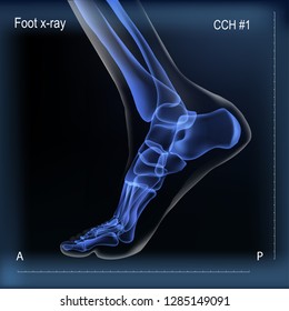 Vector realistic dark navy blue x ray of skeleton of foot. Human leg bones. Anatomy of joints. Medial view. For advertising or medical publications. Illustration stock vector.