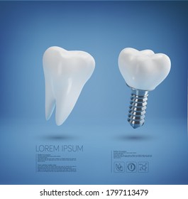 Vector with realistic dental implant and healthy tooth on a blue background. 3d. Element for design, layout template for dental clinics