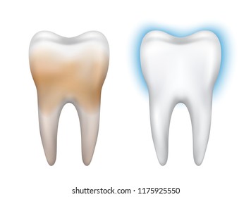 Vector realistic dirty and clean tooth model - whitening, dental hygiene, health