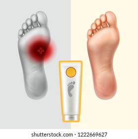 Vector realistic illustration of soles with painful point and healthy isolated on background. Concept applying cream for skin care and neutralization of pain