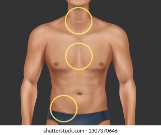 Vector realistic illustration of sunburnt man torso with healed scars at neck, thorax and groin after surgical operation. Part of the male figure isolated on dark background. Medical concept