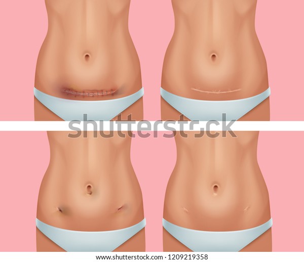 腹部の女性の体に新鮮で癒された傷跡 腹部手術と腹腔鏡からの外科手術 背景に沿ったベクター画像のリアルなセット のベクター画像素材 ロイヤリティフリー