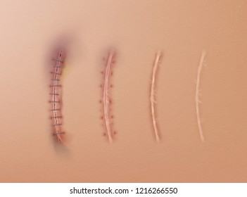 Vector realistic set of surgical sutures and scars, stitched wounds at different healing stages isolated on skin background
