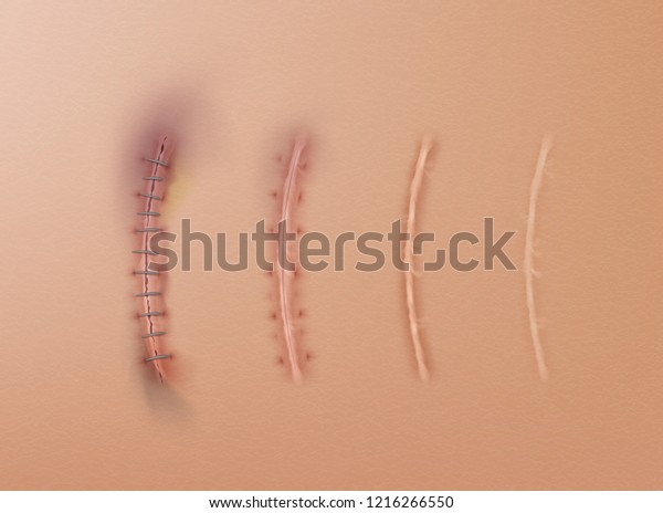 Vector realistic set of surgical sutures and\
scars, stitched wounds at different healing stages isolated on skin\
background