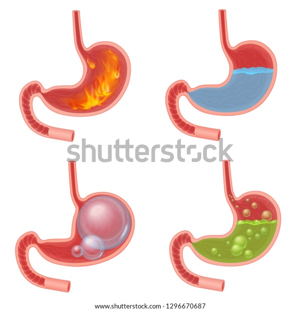 ベクターリアルな胃の医療ベクターイラストセット 黒内障 胃酸逆流 腹部の膨らんだ球 緑色の液体の吐き気 のベクター画像素材 ロイヤリティフリー