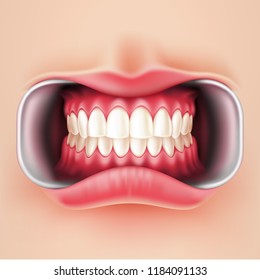 Vector realistic straight teeth after braces dental installation, brakets system. Teeth care, dentist medical concept. Oral hygiene, orthodontics treatment. Healthcare, correct bite