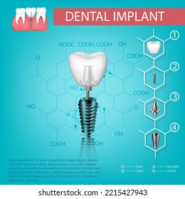 Vector realistic tooth. Structural elements of a dental implant. Infographic for medical poster
