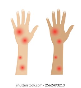 vector: red bumps on the skin of the hands due to allergies or insect bites