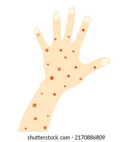 Vector - Red spot on hand and arm. Skin disease, Monkeypox. Healthcare, medical concept.