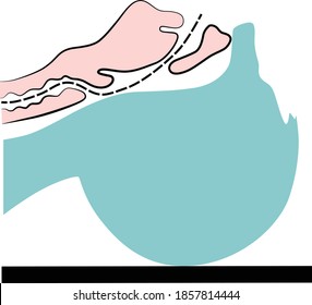 Vector scheme of artificial respiration by blowing air through the victim's mouth or nose
