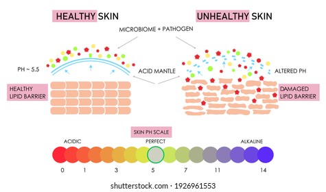 Vector scientific scheme of healthy and damaged skin building, comparison. Acidic alkaline ph scale impact on lipid barrier acid mantle. Microbiome protection film layer. Anatomical info graphic poster