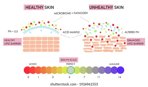 Esquema científico vectorial de construcción de piel sana y dañada, comparación. Impacto de la escala de ph alcalina ácida en el manto ácido de la barrera lipídica. Capa de película de protección microbiana. Afiche gráfico de información anatómica