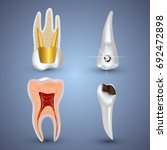 Vector set of 3d realistic clean and dirty tooth isolated on gray background. Dental health Concept. Oral Care, teeth restoration
