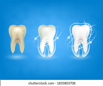 Vector set of 3d realistic clean and dirty tooth on blue background, clearing tooth process. Teeth Whitening. Dental health Concept. Oral Care, teeth restoration