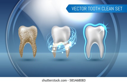 Vector set of 3d realistic clean and dirty tooth on blue background, clearing tooth process. Teeth Whitening. Dental health Concept. Oral Care, teeth restoration