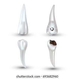 Vector set of 3d realistic clean and dirty tooth isolated on white background. Dental health Concept. Oral Care, teeth restoration