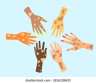 vector set of hands of all shades with vitiligo