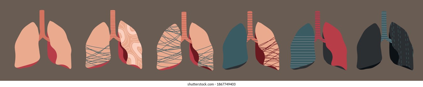 conjunto de vectores de pulmones humanos, etapas de cáncer