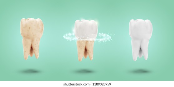 vector set of three molars. tooth cleaning, care and protection from tooth decay.