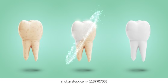 Vector Set Of Three Molars. Tooth Cleaning, Care And Protection From Tooth Decay.