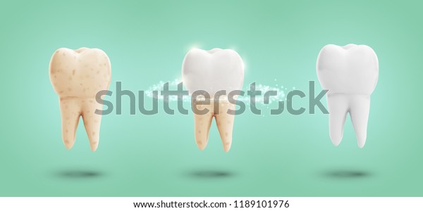 Vector Set Three Molars Tooth Cleaning Stock Vector (Royalty Free ...