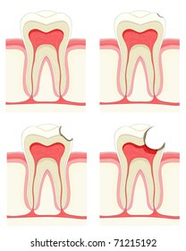 Vector set - tooth. Decay process