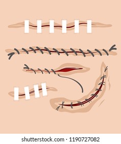 Vector set of various wounds, surgical stitches, scars