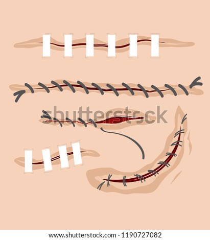 Vector set of various wounds, surgical stitches, scars
