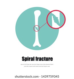 Vector sigmental fracture, human vector.