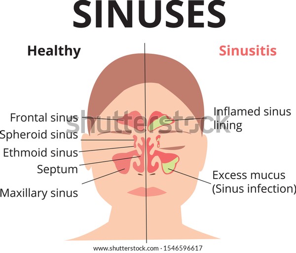 Vector Sinusitis Symptoms Icons Nasal Diseases Stock Vector Royalty