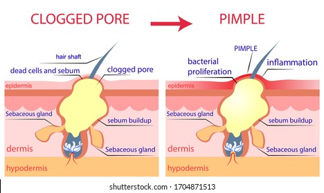 Vector skin educational infographic show how clogged pore become red papule pustule. Popping up pimple process anatomical view. Acne structure. Dead cells, sebaceous gland, inflammation, sebum buildup