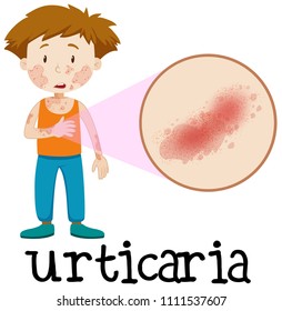 A Vector of Skin Urticaria illustration