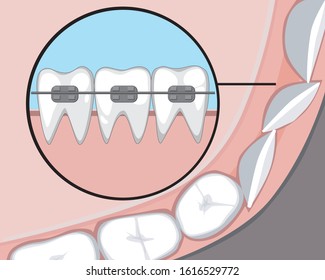 Vector Stock Illustration With Braces For Children Or Adults. Concept Of Bite Correction And Crooked Teeth. Flat Molars And Incisors Before And After The Orthodontic Clinic