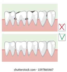A vector stock illustration with caries and a healthy tooth before and after visiting a dentist or orthodontist. A flat infographic with adult molars or permanent teeth for dental clinic