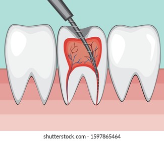 A vector stock illustration with open canal of tooth on gum and nerves as a concept of toothache. A doctor treats a molar boron machine in a dental or dental clinic and toothache