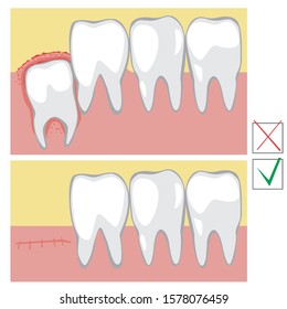 A vector stock illustration with a problem with a wisdom tooth. A molar and gum disease in the lower jaw. Infographic or poster for orthodontic or dentist clinic