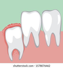 A vector stock illustration with wisdom tooth and pain. A red inflamed gum near molars and an unhealthy jaw before visiting an orthodontist or dentist