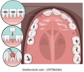 A vector stock infographic with adult jaw top view as a concept of dental treatment. A flat molars and incisors with caries on the gums, braces, implants and pulpitis for orthodontic and dental clinic