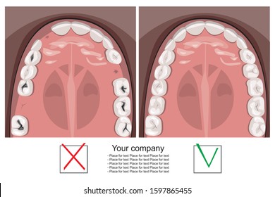 A vector stock infographic with caries and healthy teeth on the jaw for dental clinic. A flat jaw top view with palate, tooth and place for text before and after visiting the orthodontist and dentist