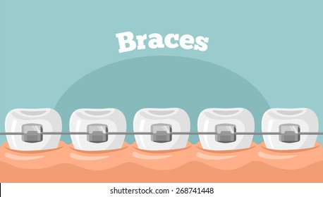 Vector Teeth Braces Flat Illustration