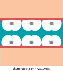 Vector teeth braces flat illustration