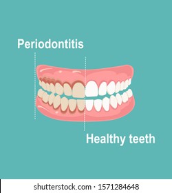 Vector of teeth and gums, healthy and affected by periodontitis 