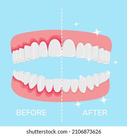 Vector of teeth and gums, healthy and affected by periodontitis.Dentistry and stomatology vector