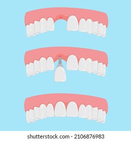 Vector  Teeth with Implant Closeup Isolated on White Background. Dentistry and Orthodontics Design. Human Teeth for Medical Prosthetics Concept
