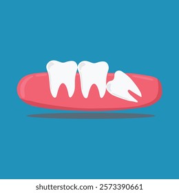 vector of three teeth with one wisdom tooth growing in a slanted position, suitable as an illustration of the position of the wisdom tooth