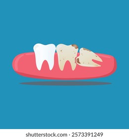 vector of three teeth with one wisdom tooth growing in a slanted position, suitable as an illustration of the position of the wisdom tooth