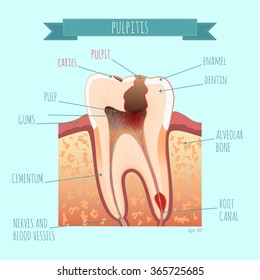 Vector tooth anatomy. Caries. Pulpit. for your design