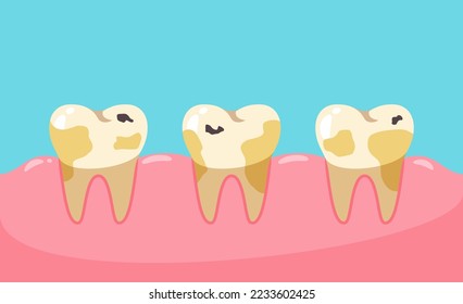 Vector unhealthy teeth. Cavities and dental plaque