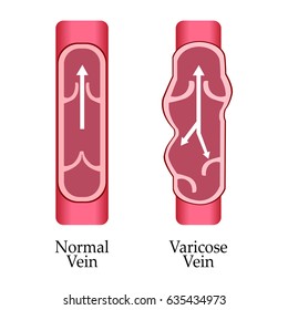 Vector Varicose Vein And Normal Vein. Varicose Vein.