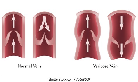 Vector Varicose vena e ilustración vena normal.